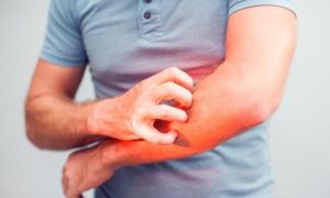 Inilah Tanda-Tanda Alergi Kulit